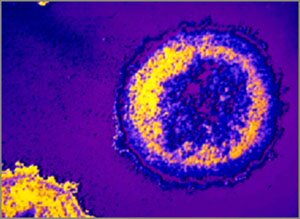 T-cell infected with HIV